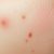 Wizyta u dermatologa – naprawdę warto