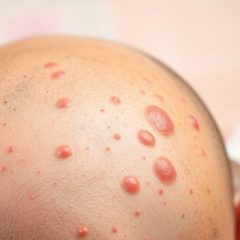 Trądzik głowy: przyczyny, objawy i skuteczne leczenie